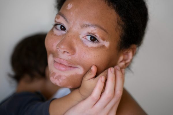 Vitiligo Hastalığı Nedir?
