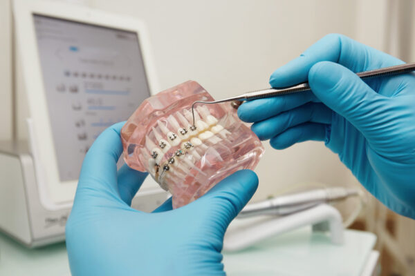 diş teli tedavisi ve aşamaları