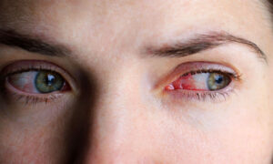 Göz Enfeksiyonu Belirtlieri