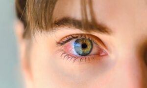 Göz Enfeksiyonu Tedavisi Nasıl Yapılır