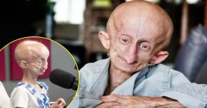 Progeria