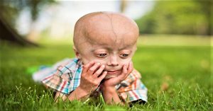 Progeria