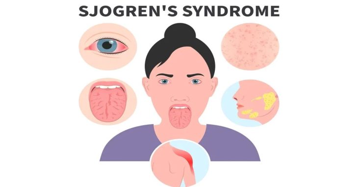 Sjögren