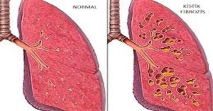 Kistik Fibrozis