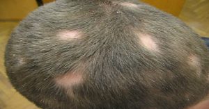 Dermatofitoz